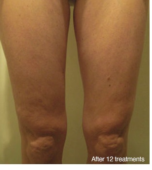 Cellulite is diminished after 12 treatments