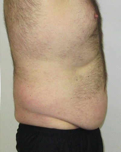 After Contour Light, Fat has been reduced after 12 sessions