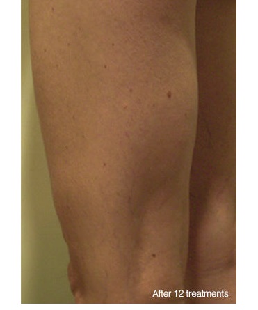 Back of legs after Contour Light, Cellulite is gone after 12 treatments!